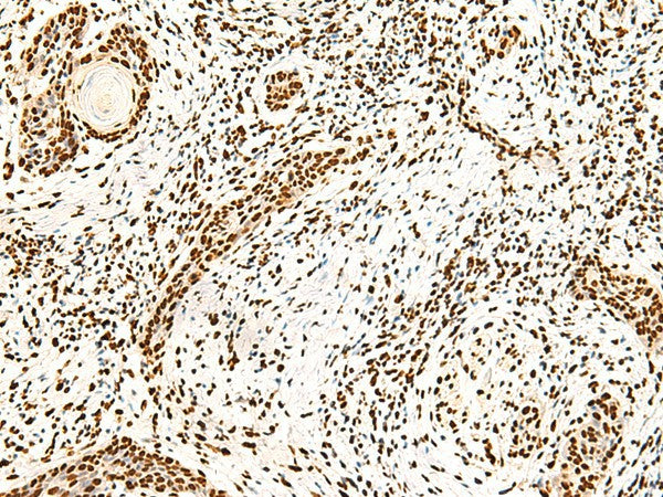Immunohistochemistry of paraffin-embedded Human esophagus cancer tissue using ILF3 Polyclonal Antibody at dilution of 1:40(×200)