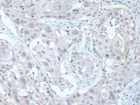 Immunohistochemistry of paraffin-embedded Human esophagus cancer tissue using ANGPTL6 Polyclonal Antibody at dilution of 1:55(×200)