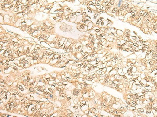 Immunohistochemistry of paraffin-embedded Human gastric cancer tissue using DMC1 Polyclonal Antibody at dilution of 1:30(×200)