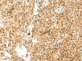 Immunohistochemistry of paraffin-embedded Human cervical cancer tissue using PAF1 Polyclonal Antibody at dilution of 1:55(×200)