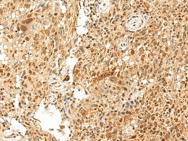 Immunohistochemistry of paraffin-embedded Human cervical cancer tissue using PAF1 Polyclonal Antibody at dilution of 1:55(×200)