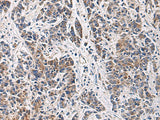 Immunohistochemistry of paraffin-embedded Human colorectal cancer tissue using HSDL2 Polyclonal Antibody at dilution of 1:80(×200)