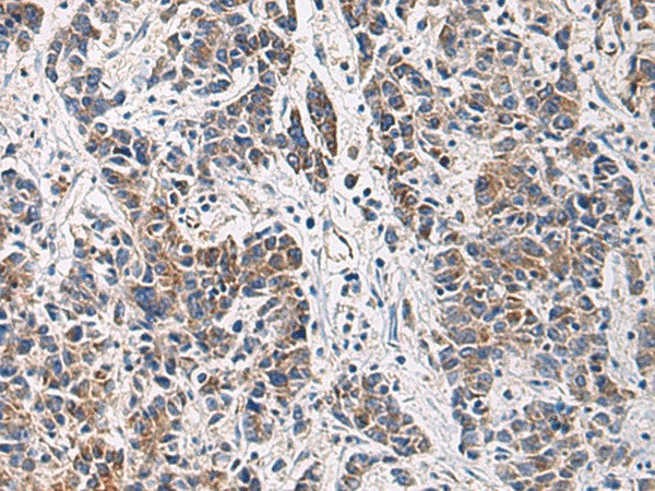 Immunohistochemistry of paraffin-embedded Human colorectal cancer tissue using HSDL2 Polyclonal Antibody at dilution of 1:80(×200)
