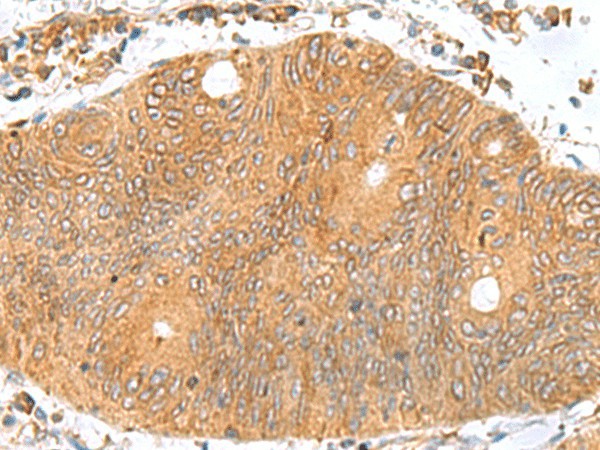 Immunohistochemistry of paraffin-embedded Human colorectal cancer tissue using TXNDC12 Polyclonal Antibody at dilution of 1:70(×200)