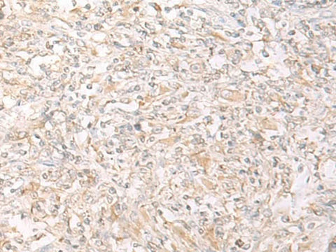 Immunohistochemistry of paraffin-embedded Human liver cancer tissue using IL12B Polyclonal Antibody at dilution of 1:45(×200)