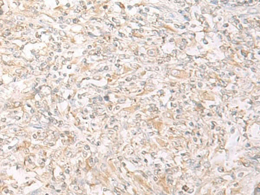 Immunohistochemistry of paraffin-embedded Human liver cancer tissue using IL12B Polyclonal Antibody at dilution of 1:45(×200)