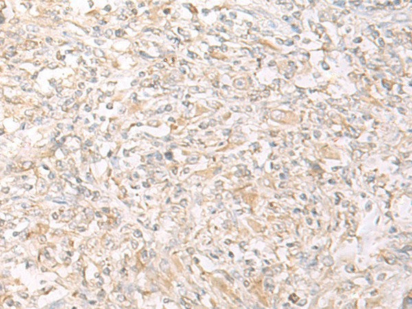 Immunohistochemistry of paraffin-embedded Human liver cancer tissue using IL12B Polyclonal Antibody at dilution of 1:45(×200)