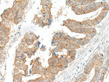 Immunohistochemistry of paraffin-embedded Human colorectal cancer tissue using SLC6A9 Polyclonal Antibody at dilution of 1:25(×200)