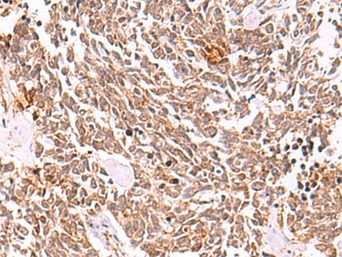 Immunohistochemistry of paraffin-embedded Human lung cancer tissue using COPS3 Polyclonal Antibody at dilution of 1:50(×200)