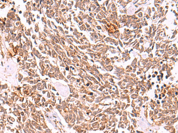 Immunohistochemistry of paraffin-embedded Human lung cancer tissue using COPS3 Polyclonal Antibody at dilution of 1:50(×200)