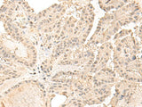 Immunohistochemistry of paraffin-embedded Human thyroid cancer tissue using ZGPAT Polyclonal Antibody at dilution of 1:35(×200)
