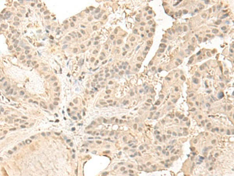 Immunohistochemistry of paraffin-embedded Human thyroid cancer tissue using ZGPAT Polyclonal Antibody at dilution of 1:35(×200)