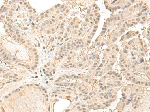 Immunohistochemistry of paraffin-embedded Human thyroid cancer tissue using ZGPAT Polyclonal Antibody at dilution of 1:35(×200)