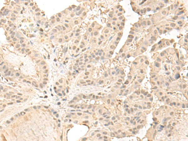 Immunohistochemistry of paraffin-embedded Human thyroid cancer tissue using ZGPAT Polyclonal Antibody at dilution of 1:35(×200)
