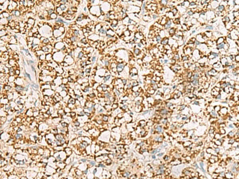 Immunohistochemistry of paraffin-embedded Human liver cancer tissue using ISOC2 Polyclonal Antibody at dilution of 1:95(×200)