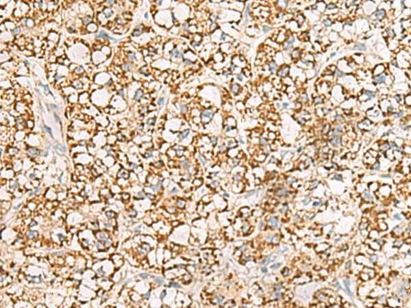Immunohistochemistry of paraffin-embedded Human liver cancer tissue using ISOC2 Polyclonal Antibody at dilution of 1:95(×200)
