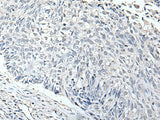 Immunohistochemistry of paraffin-embedded Human lung cancer tissue using RERG Polyclonal Antibody at dilution of 1:65(×200)