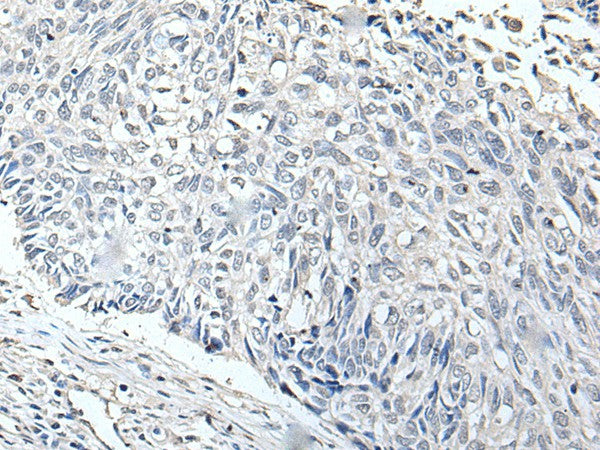 Immunohistochemistry of paraffin-embedded Human lung cancer tissue using RERG Polyclonal Antibody at dilution of 1:65(×200)