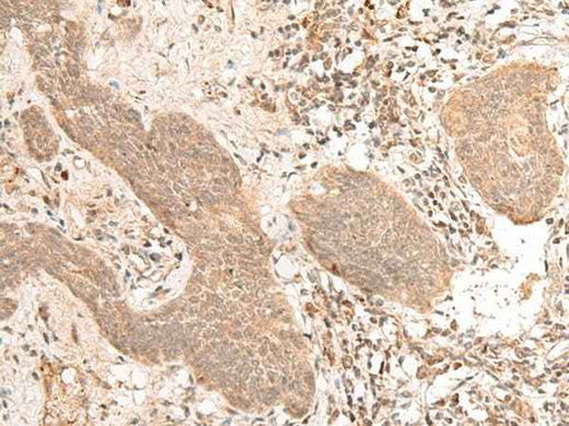 Immunohistochemistry of paraffin-embedded Human esophagus cancer tissue using FIZ1 Polyclonal Antibody at dilution of 1:40(×200)