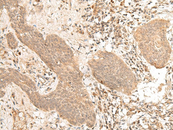 Immunohistochemistry of paraffin-embedded Human esophagus cancer tissue using FIZ1 Polyclonal Antibody at dilution of 1:40(×200)