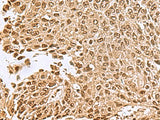 Immunohistochemistry of paraffin-embedded Human lung cancer tissue using NVL Polyclonal Antibody at dilution of 1:70(×200)