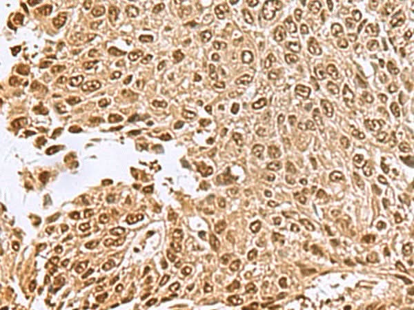 Immunohistochemistry of paraffin-embedded Human lung cancer tissue using NVL Polyclonal Antibody at dilution of 1:70(×200)
