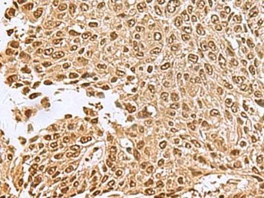 Immunohistochemistry of paraffin-embedded Human lung cancer tissue using NVL Polyclonal Antibody at dilution of 1:70(×200)