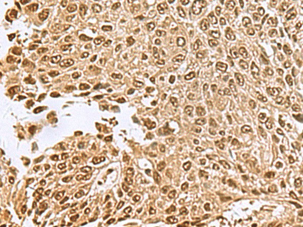 Immunohistochemistry of paraffin-embedded Human lung cancer tissue using NVL Polyclonal Antibody at dilution of 1:70(×200)