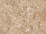 Immunohistochemistry of paraffin-embedded Human ovarian cancer tissue using SNAPC5 Polyclonal Antibody at dilution of 1:25(×200)