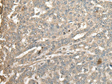 Immunohistochemistry of paraffin-embedded Human liver cancer tissue using ATXN3 Polyclonal Antibody at dilution of 1:100(×200)