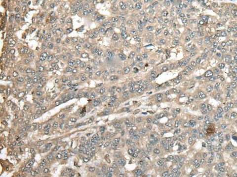 Immunohistochemistry of paraffin-embedded Human liver cancer tissue using ATXN3 Polyclonal Antibody at dilution of 1:100(×200)