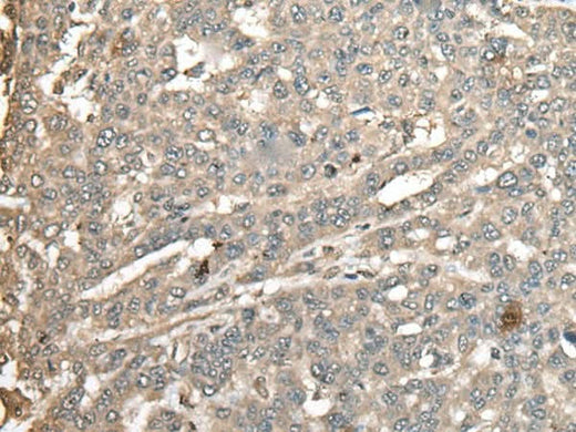 Immunohistochemistry of paraffin-embedded Human liver cancer tissue using ATXN3 Polyclonal Antibody at dilution of 1:100(×200)