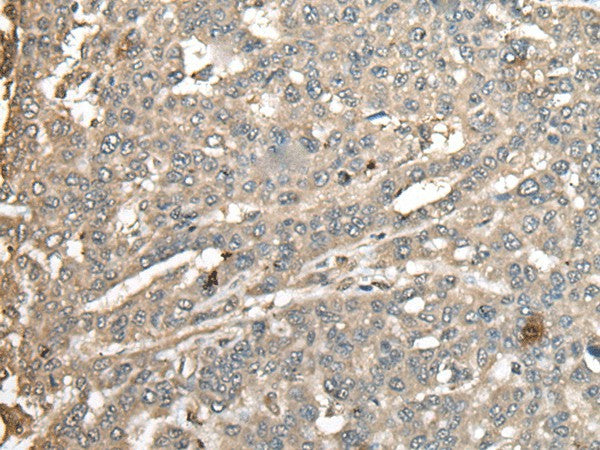 Immunohistochemistry of paraffin-embedded Human liver cancer tissue using ATXN3 Polyclonal Antibody at dilution of 1:100(×200)