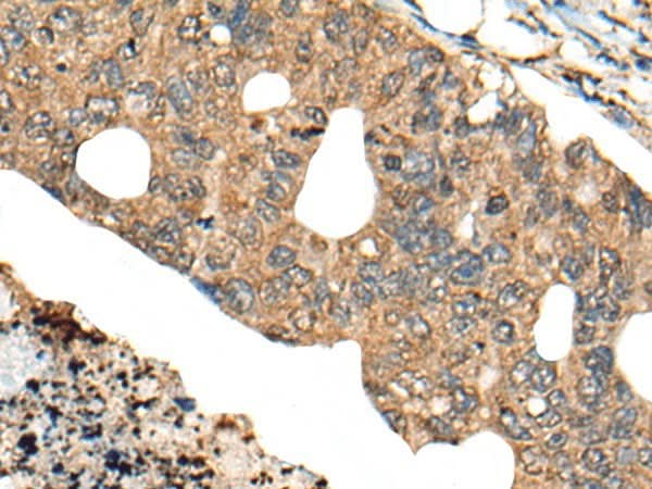 Immunohistochemistry of paraffin-embedded Human colorectal cancer tissue using PPP3R1 Polyclonal Antibody at dilution of 1:80(×200)