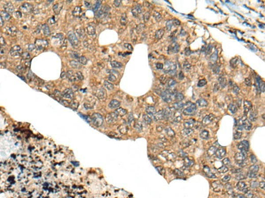 Immunohistochemistry of paraffin-embedded Human colorectal cancer tissue using PPP3R1 Polyclonal Antibody at dilution of 1:80(×200)