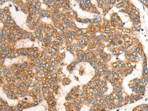 Immunohistochemistry of paraffin-embedded Human liver cancer tissue using CDON Polyclonal Antibody at dilution of 1:65(×200)