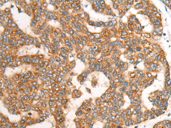 Immunohistochemistry of paraffin-embedded Human liver cancer tissue using CDON Polyclonal Antibody at dilution of 1:65(×200)