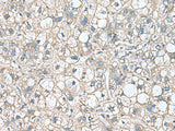 Immunohistochemistry of paraffin-embedded Human liver cancer tissue using RHBDL2 Polyclonal Antibody at dilution of 1:110(×200)