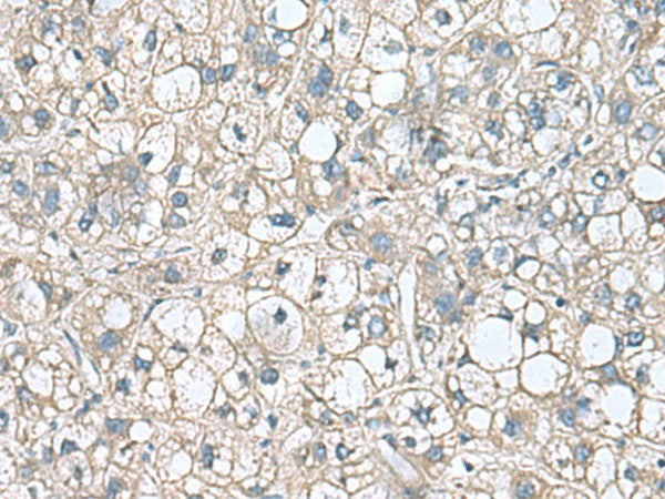 Immunohistochemistry of paraffin-embedded Human liver cancer tissue using RHBDL2 Polyclonal Antibody at dilution of 1:110(×200)