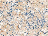 Immunohistochemistry of paraffin-embedded Human liver cancer tissue using DUSP7 Polyclonal Antibody at dilution of 1:50(×200)