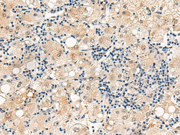 Immunohistochemistry of paraffin-embedded Human liver cancer tissue using DUSP7 Polyclonal Antibody at dilution of 1:50(×200)