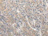 Immunohistochemistry of paraffin-embedded Human liver cancer tissue using CLIC6 Polyclonal Antibody at dilution of 1:40(×200)