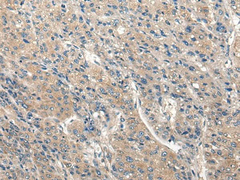 Immunohistochemistry of paraffin-embedded Human liver cancer tissue using CLIC6 Polyclonal Antibody at dilution of 1:40(×200)