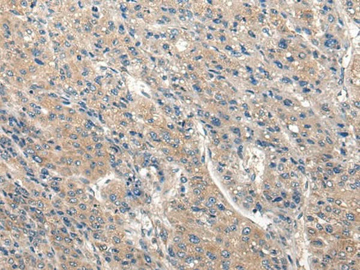 Immunohistochemistry of paraffin-embedded Human liver cancer tissue using CLIC6 Polyclonal Antibody at dilution of 1:40(×200)