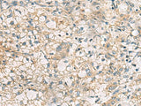 Immunohistochemistry of paraffin-embedded Human liver cancer tissue using RTP4 Polyclonal Antibody at dilution of 1:50(×200)