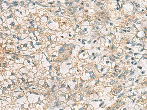 Immunohistochemistry of paraffin-embedded Human liver cancer tissue using RTP4 Polyclonal Antibody at dilution of 1:50(×200)
