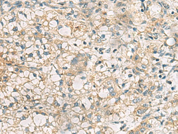 Immunohistochemistry of paraffin-embedded Human liver cancer tissue using RTP4 Polyclonal Antibody at dilution of 1:50(×200)