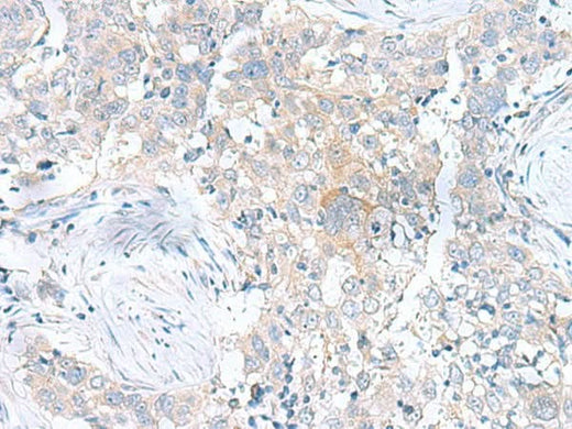 Immunohistochemistry of paraffin-embedded Human esophagus cancer tissue using UBE2F Polyclonal Antibody at dilution of 1:100(×200)