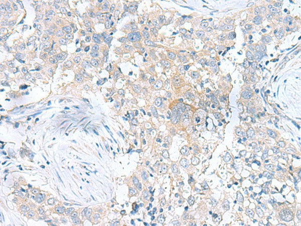 Immunohistochemistry of paraffin-embedded Human esophagus cancer tissue using UBE2F Polyclonal Antibody at dilution of 1:100(×200)