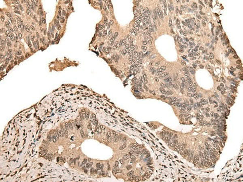 Immunohistochemistry of paraffin-embedded Human colorectal cancer tissue using ZSCAN12 Polyclonal Antibody at dilution of 1:50(×200)